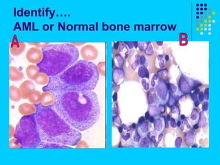 Normal Marrow Elements Leukemia | PPT