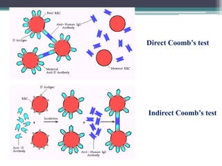 Direct Coomb’s test
Indirect Coomb’s test
 