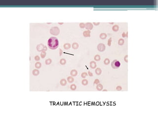 TRAUMATIC HEMOLYSIS
 