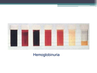 Hemoglobinuria
 