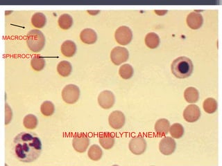 IMMUNOHEMOLYTIC ANEMIA
MACROCYTE
SPHEROCYTE
 