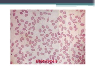 Elliptocytosis
 