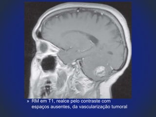 » RM em T1, realce pelo contraste com
espaços ausentes, da vascularização tumoral
 