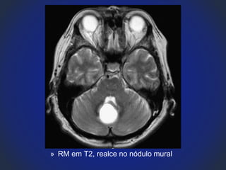 » RM em T2, realce no nódulo mural
 