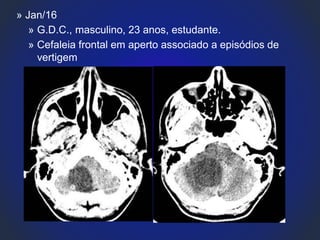 » Jan/16
» G.D.C., masculino, 23 anos, estudante.
» Cefaleia frontal em aperto associado a episódios de
vertigem
 