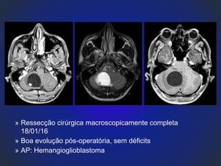 » Ressecção cirúrgica macroscopicamente completa
18/01/16
» Boa evolução pós-operatória, sem déficits
» AP: Hemangioglioblastoma
 
