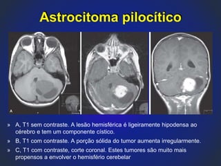 » A, T1 sem contraste. A lesão hemisférica é ligeiramente hipodensa ao
cérebro e tem um componente cístico.
» B, T1 com contraste. A porção sólida do tumor aumenta irregularmente.
» C, T1 com contraste, corte coronal. Estes tumores são muito mais
propensos a envolver o hemisfério cerebelar
Astrocitoma pilocítico
 