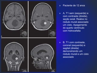 » Paciente de 12 anos
» A, T1 sem (esquerda) e
com contraste (direita),
seção axial. Realce no
nódulo mural associado
um cisto. Apagamento
do quarto ventrículo
com hidrocefalia
» B, T1 com contraste,
coronal (esquerda) e
sagital (direita)
demonstrando um
nódulo mural e um cisto
associado
 