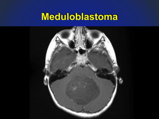 Meduloblastoma
 