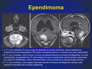 » A, T1 com contraste. O tumor surge do assoalho do quarto ventrículo, edema perilesional,
contrasta de forma heterogênea. Por vezes é bastante grande no momento em que é descoberto.
» B, T1 com contraste, corte coronal. O tumor se estende através do forame de Magendie, um sinal
característico de ependimoma. É mais irregular do que a maioria dos outros tumores nessa área
por causa de calcificação, cistos, hemoderivados, focos necróticos e vascularização tumoral.
» C, T1 com contraste, corte sagital. Extensão através do forame de Magendie, também está
causando herniação das tonsilas cerebelares.
Ependimoma
 