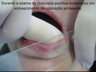 Durante o exame de diascopia positivo evidenciou um
      esmaecimento da coloração arroxeada;
 