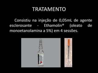 TRATAMENTO
   Consistiu na injeção de 0,05mL de agente
esclerosante - Ethamolin® (oleato de
monoetanolamina a 5%) em 4 sessões.
 