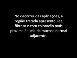 No decorrer das aplicações, a
   região tratada apresentou-se
   fibrosa e com coloração mais
próxima àquela da mucosa normal
             adjacente.
 