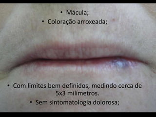 • Mácula;
           • Coloração arroxeada;




• Com limites bem definidos, medindo cerca de
                5x3 milímetros.
       • Sem sintomatologia dolorosa;
 