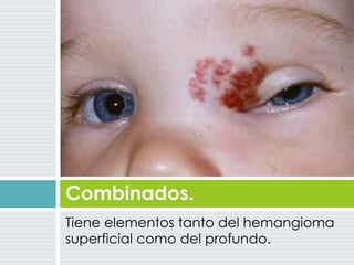 Tiene elementos tanto del hemangioma
superficial como del profundo.
Combinados.
 