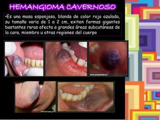 HEMANGIOMA CAVERNOSO
•Es una masa esponjosa, blanda de color rojo azulada,
su tamaño varia de 1 a 2 cm, exiten formas gigantes
bastantes raras afecta a grandes áreas subcutáneas de
la cara, miembro u otras regiones del cuerpo
 