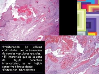 •Proliferación de células
endoteliales, con la formación
de canales vasculares grandes.
• El interstisio que es la zona
de tejido conectivo
intervascular, es un tejido
conectivo fibroso denso.
•Eritrocitos, fibroblastos.
 