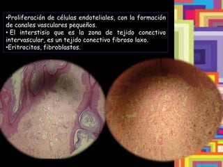 •Proliferación de células endoteliales, con la formación
de canales vasculares pequeños.
• El interstisio que es la zona de tejido conectivo
intervascular, es un tejido conectivo fibroso laxo.
•Eritrocitos, fibroblastos.
 