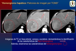“ Hemangioma hepático:  Patrones de imagen por TCMD” Imágenes de TC en fase arterial, venosa y excretora  demostrándose la identificación de las características del  flash   hemangioma  . Además, obsérvense las características del  hemangioma típico  . 