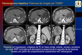 “ Hemangioma hepático:  Patrones de imagen por TCMD” Paciente con hepatopatia, imágenes de TC en fases simple, arterial, venosa y excretora así como RMP coronales que demuestra la presencia de la segunda de las lesiones focales con patrón de comportamiento característico del  hemangioma. 