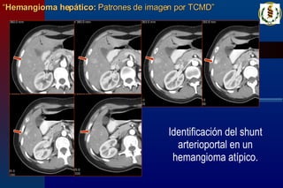 Identificación del shunt arterioportal en un hemangioma atípico. “ Hemangioma hepático:  Patrones de imagen por TCMD” 