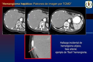 “ Hemangioma hepático:  Patrones de imagen por TCMD” Hallazgo incidental de  hemangioma atípico,  fase arterial,  ejemplo de  “flash”  hemangioma. 
