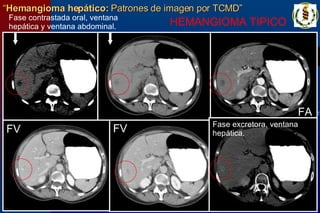 “ Hemangioma hepático:  Patrones de imagen por TCMD” HEMANGIOMA TIPICO   Fase contrastada oral, ventana hepática y ventana abdominal. FA FV FV Fase excretora, ventana hepática. 