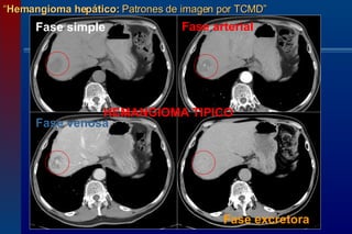 “ Hemangioma hepático:  Patrones de imagen por TCMD” HEMANGIOMA TIPICO   Fase simple  Fase arterial  Fase venosa  Fase excretora 