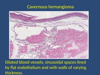 Dilated blood vessels, sinusoidal spaces lined
by flat endothelium and with walls of varying
thickness.
Cavernous hemangioma
 