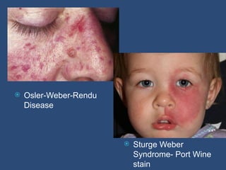  Osler-Weber-Rendu
Disease
 Sturge Weber
Syndrome- Port Wine
stain
 