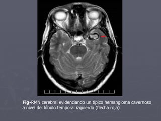 Fig- RMN cerebral evidenciando un típico hemangioma cavernoso  a nivel del lóbulo temporal izquierdo (flecha roja)  