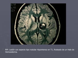 RM: Lesión con aspecto tipo nodular Hipointenso en T1, Rodeado de un Halo de Hemosiderina. 