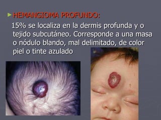 HEMANGIOMA PROFUNDO:  15% se localiza en la dermis profunda y o tejido subcutáneo. Corresponde a una masa o nódulo blando, mal delimitado, de color piel o tinte azulado  