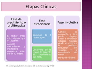 Etapas Clínicas
Fase de
crecimiento o
proliferativa
El tumor crece
más rápido que
el lactante.
Alcanza
crecimiento y
morfología
completa antes
de los 12 meses.
Fase
estacionaria
Duración de 6
meses aprox.
Desarrollo de la
lesión de acuerdo
al crecimiento
del niño.
Fase involutiva
Cambio de
coloración a tono
pardo o púrpura,
luego a coloración
grisácea moteada
desde el centro a
la periferia.
Reducción del
volumen y la
consistencia del
tumor.
Duración variable.
Ref. Arnoldo Quezada, Pediatría Ambulatoria, 2003 Ed. Medirerraneo. Pág. 417-418
 