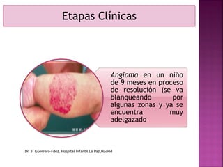 Etapas Clínicas
Angioma en un niño
de 9 meses en proceso
de resolución (se va
blanqueando por
algunas zonas y ya se
encuentra muy
adelgazado
Dr. J. Guerrero-Fdez. Hospital Infantil La Paz,Madrid
 
