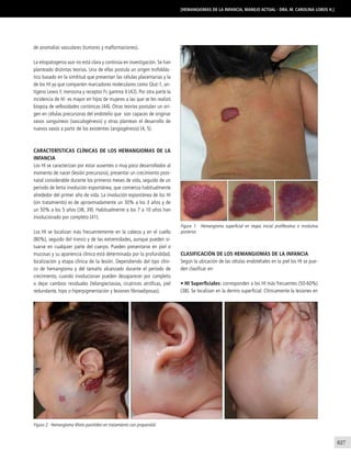 827
[Hemangiomas de la infancia, manejo actual - Dra. M. Carolina Lobos H.]
de anomalías vasculares (tumores y malformaciones).
La etiopatogenia aun no está clara y continúa en investigación. Se han
planteado distintas teorías. Una de ellas postula un origen trofoblás-
tico basado en la similitud que presentan las células placentarias y la
de los HI ya que comparten marcadores moleculares como Glut-1, an-
tígeno Lewis Y, merosina y receptor Fc gamma II (42). Por otra parte la
incidencia de HI es mayor en hijos de mujeres a las que se les realizó
biopsia de vellosidades coriónicas (44). Otras teorías postulan un ori-
gen en células precursoras del endotelio que son capaces de originar
vasos sanguíneos (vasculogénesis) y otras plantean el desarrollo de
nuevos vasos a partir de los existentes (angiogénesis) (4, 5).
Características clínicas de los Hemangiomas de la
infancia
Los HI se caracterizan por estar ausentes o muy poco desarrollados al
momento de nacer (lesión precursora), presentar un crecimiento post-
natal considerable durante los primeros meses de vida, seguido de un
período de lenta involución espontánea, que comienza habitualmente
alrededor del primer año de vida. La involución espontánea de los HI
(sin tratamiento) es de aproximadamente un 30% a los 3 años y de
un 50% a los 5 años (38, 39). Habitualmente a los 7 a 10 años han
involucionado por completo (41).
Los HI se localizan más frecuentemente en la cabeza y en el cuello
(80%), seguido del tronco y de las extremidades, aunque pueden si-
tuarse en cualquier parte del cuerpo. Pueden presentarse en piel o
mucosas y su apariencia clínica está determinada por la profundidad,
localización y etapa clínica de la lesión. Dependiendo del tipo clíni-
co de hemangioma y del tamaño alcanzado durante el período de
crecimiento, cuando involucionan pueden desaparecer por completo
o dejar cambios residuales (telangiectasias, cicatrices atróficas, piel
redundante, hipo o hiperpigmentación y lesiones fibroadiposas).
Figura 2. Hemangioma Mixto parotídeo en tratamiento con propanolol.
Figura 1. Hemangioma superficial en etapa inicial proliferativa e involutiva
posterior.
Clasificación de los Hemangiomas de la Infancia
Según la ubicación de las células endoteliales en la piel los HI se pue-
den clasificar en:
• HI Superficiales: corresponden a los HI más frecuentes (50-60%)
(38). Se localizan en la dermis superficial. Clínicamente la lesiones en
 