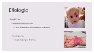 Etiología
◦ Pueden ser
◦ Malformaciones vasculares
◦ Células endoteliales que no proliferan ni involucionan
◦ Hemangiomas
◦ Neoplasias benignas dinámicas
 