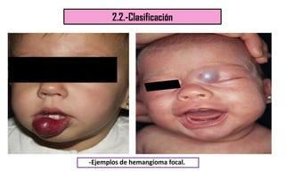 2.2.-Clasificación
-Ejemplos de hemangioma focal.
 