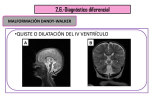 2.6.-Diagnóstico diferencial
•QUISTE O DILATACIÓN DEL IV VENTRÍCULO
MALFORMACIÓN DANDY-WALKER
 