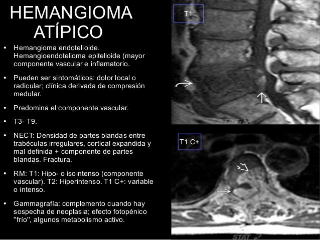 Revisión de tema. Hemangioma vertebral