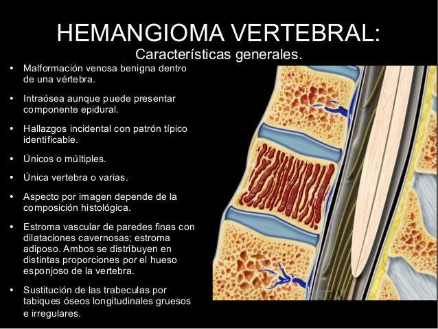 El tratamiento eficaz a las hernias de la columna vertebral