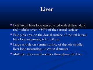 LiverLiver
 Left lateral liver lobe was covered with diffuse, darkLeft lateral liver lobe was covered with diffuse, dark
red nodules over > 80% of the serosal surface.red nodules over > 80% of the serosal surface.
 Pale pink area on the dorsal surface of the left lateralPale pink area on the dorsal surface of the left lateral
liver lobe measuring 6.4 x 3.0 cm.liver lobe measuring 6.4 x 3.0 cm.
 Large nodule on ventral surface of the left middleLarge nodule on ventral surface of the left middle
liver lobe measuring 1.4 cm in diameterliver lobe measuring 1.4 cm in diameter
 Multiple other small nodules throughout the liverMultiple other small nodules throughout the liver
 