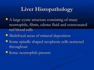 Liver HistopathologyLiver Histopathology
 A large cystic structure consisting of manyA large cystic structure consisting of many
neutrophils, fibrin, edema fluid and extravasatedneutrophils, fibrin, edema fluid and extravasated
red blood cellsred blood cells
 Multifocal areas of mineral depositionMultifocal areas of mineral deposition
 Some spindle shaped neoplastic cells scatteredSome spindle shaped neoplastic cells scattered
throughoutthroughout
 Some neutrophils presentSome neutrophils present
 