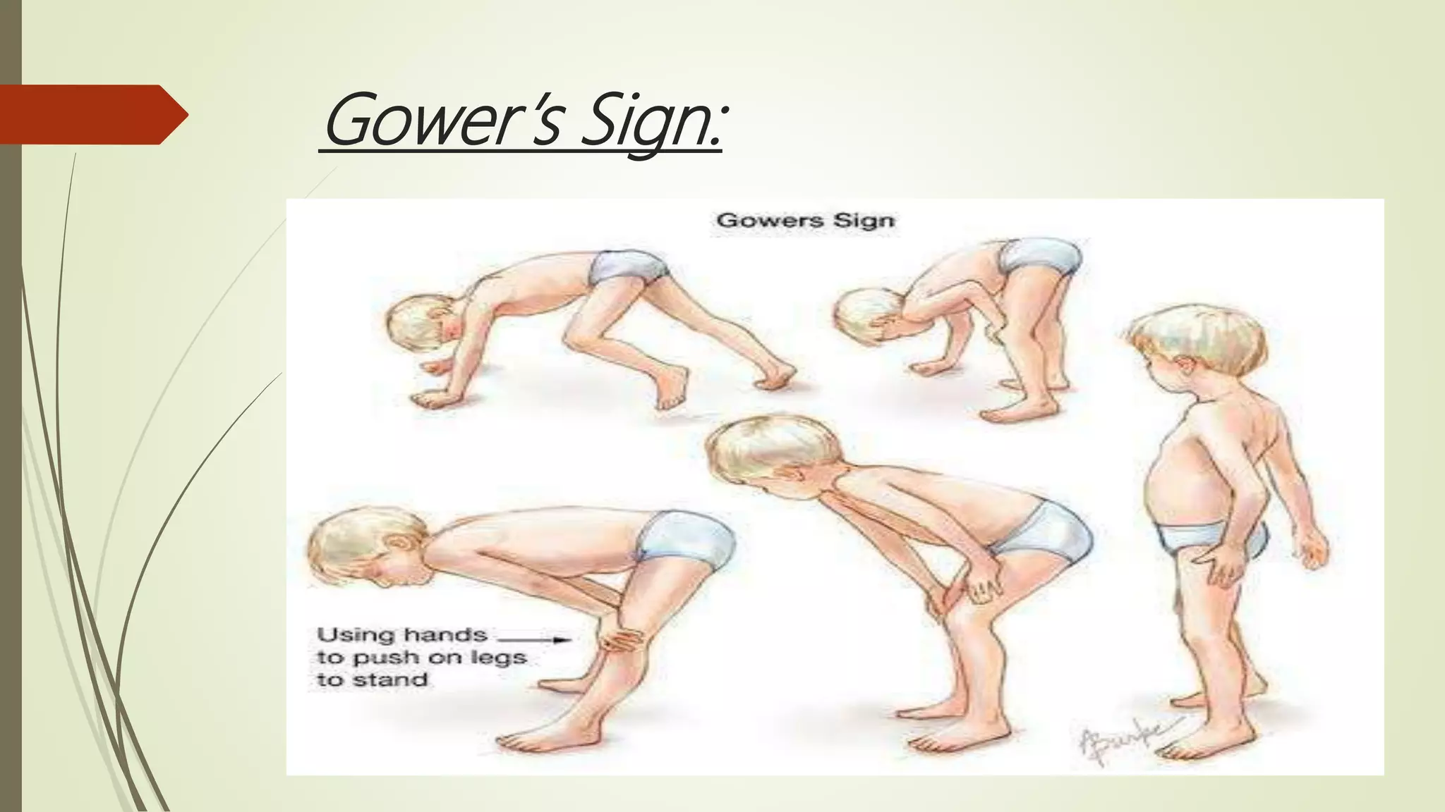 Gower’s Sign:
 