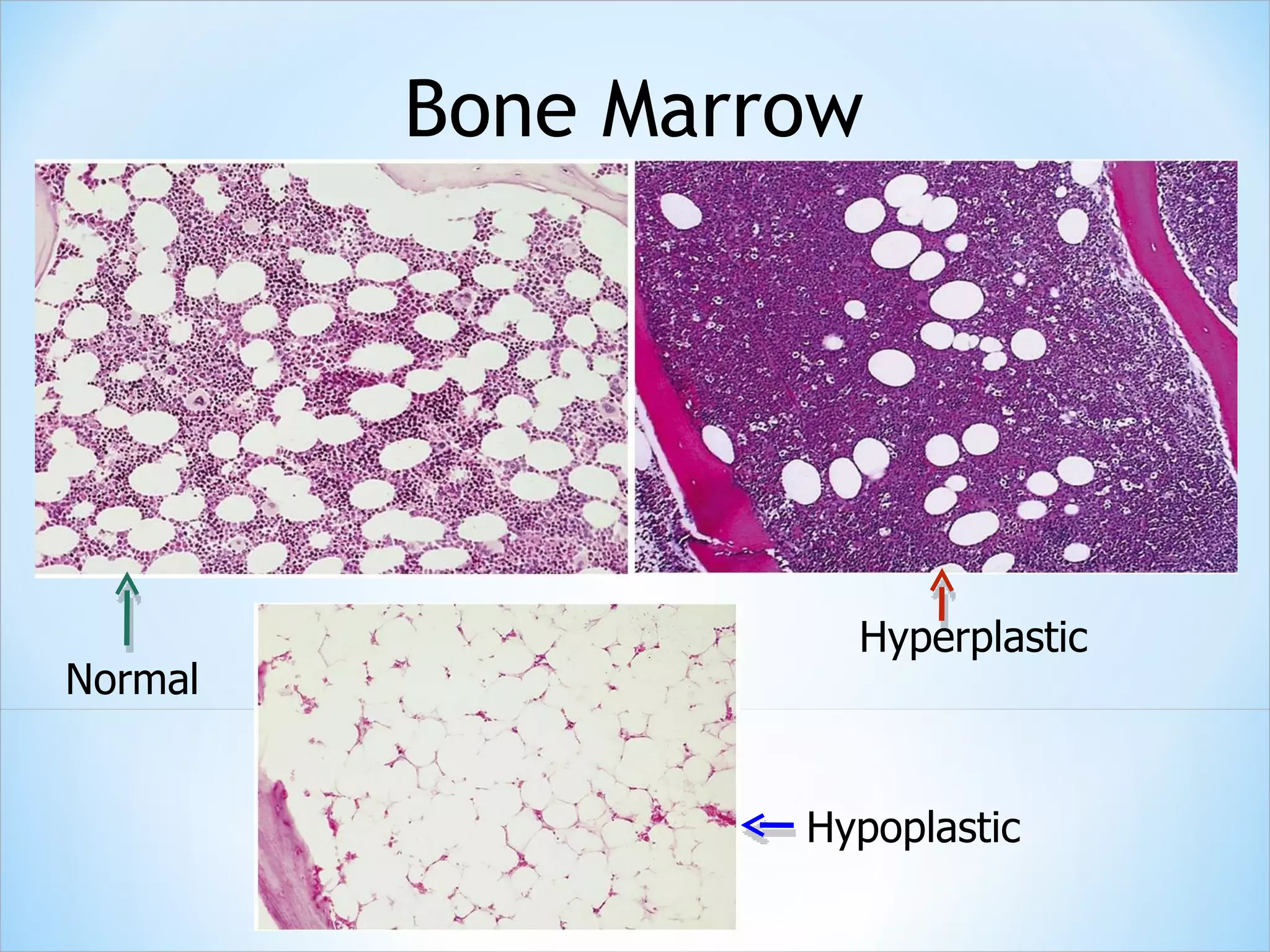 Normal Hypoplastic Hyperplastic Bone Marrow 