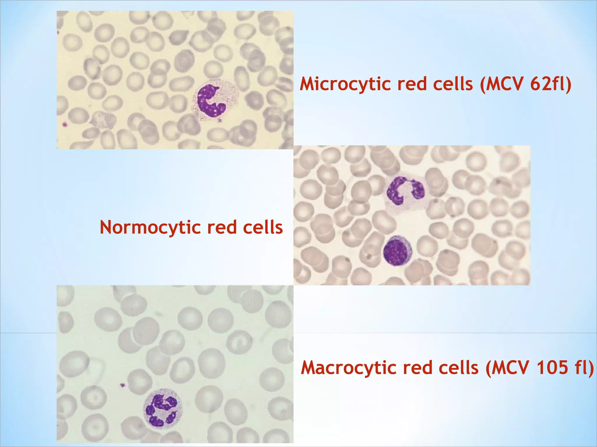 Microcytic red cells (MCV 62fl) Normocytic red cells Macrocytic red cells (MCV 105 fl) 