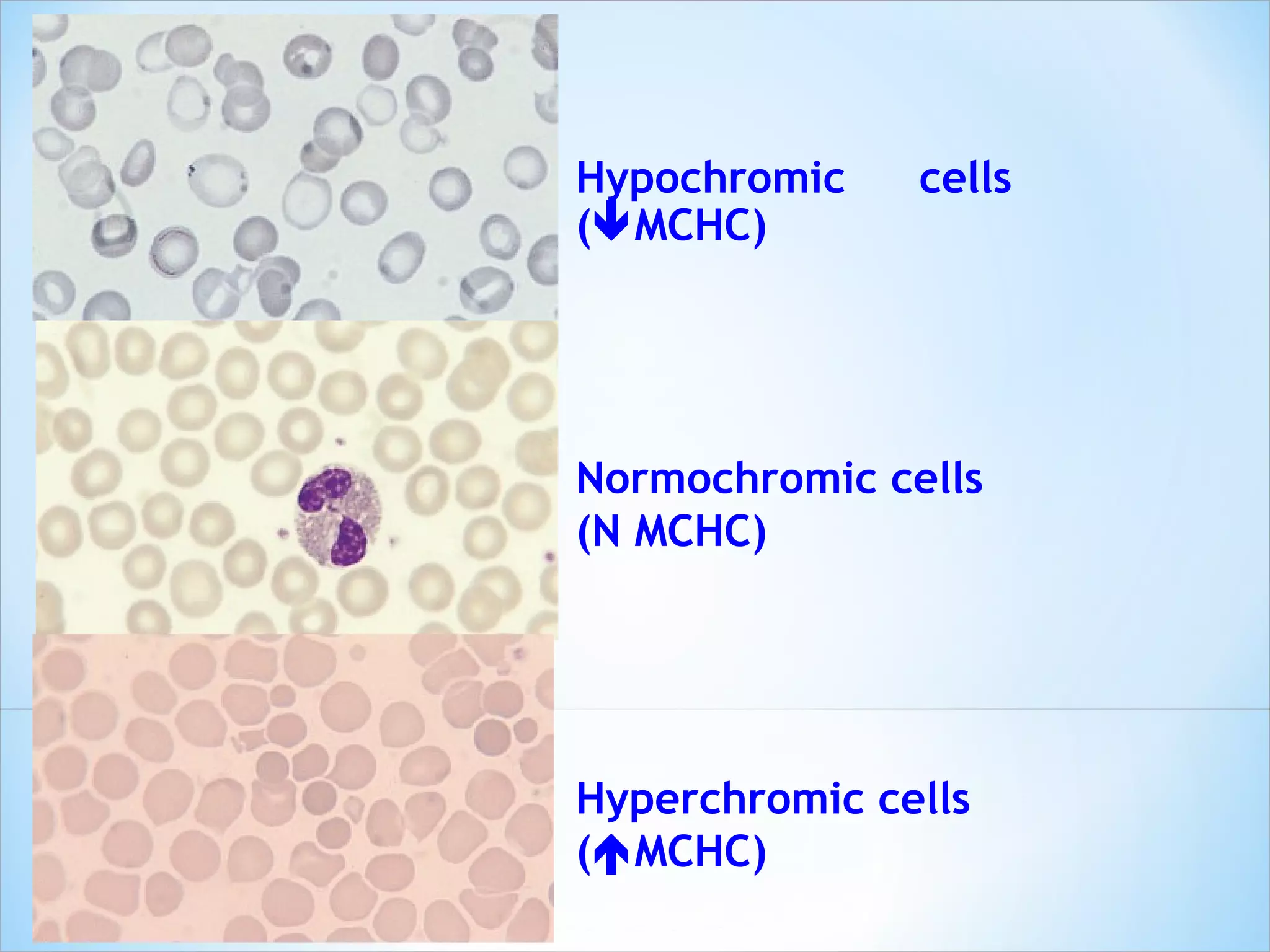 Hyperchromic cells (  MCHC) Normochromic cells  (N MCHC) Hypochromic cells (  MCHC) 