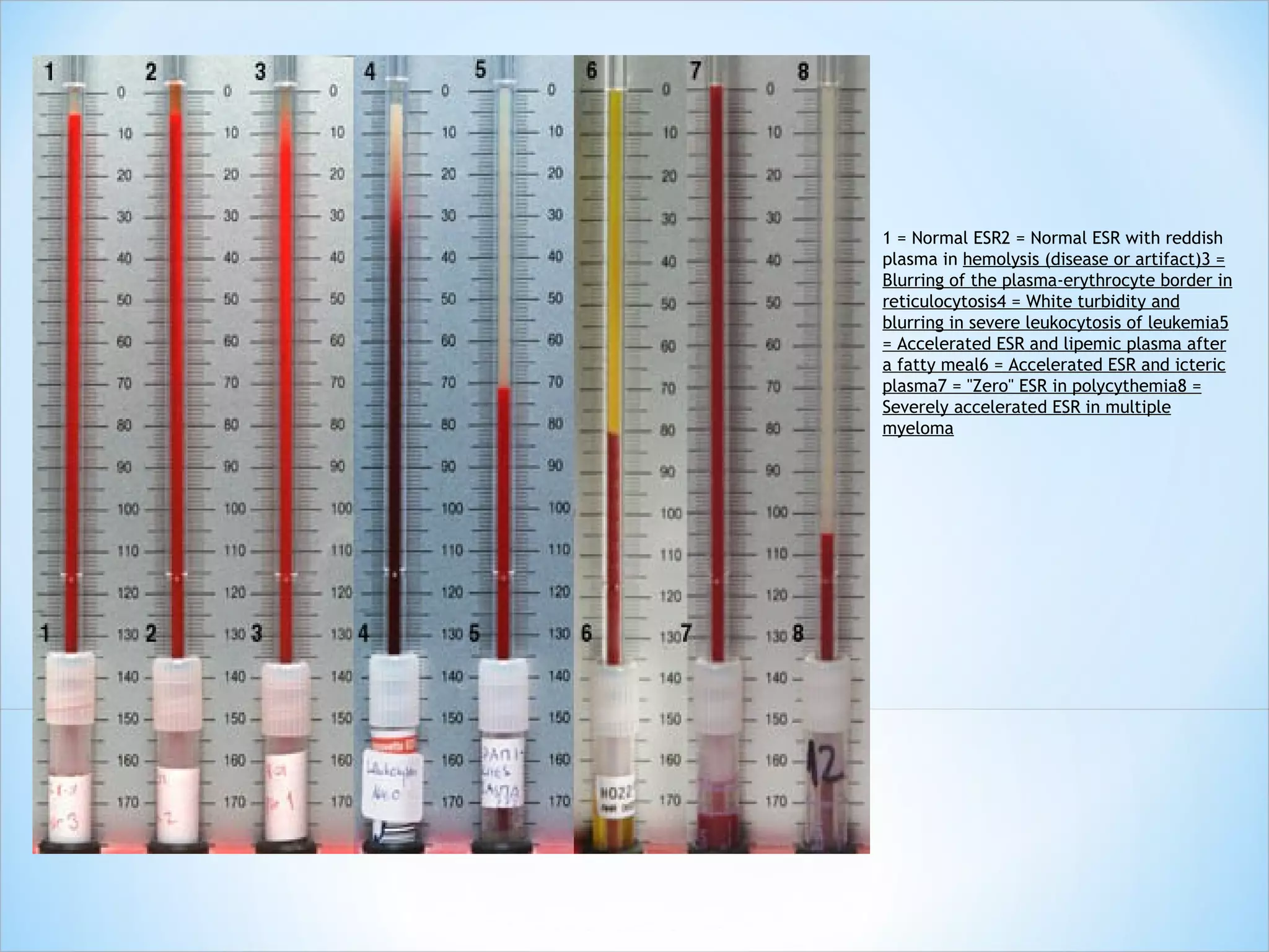 1 = Normal ESR 2 = Normal ESR with reddish plasma in  hemolysis (disease or artifact) 3 = Blurring of the plasma-erythrocyte border in reticulocytosis 4 = White turbidity and blurring in severe leukocytosis of leukemia 5 = Accelerated ESR and lipemic plasma after a fatty meal 6 = Accelerated ESR and icteric plasma 7 = "Zero" ESR in polycythemia 8 = Severely accelerated ESR in multiple myeloma 