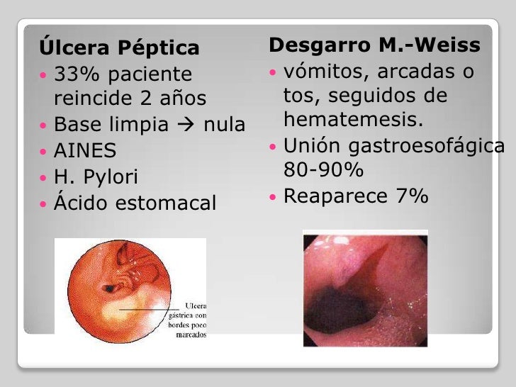 hematemesis