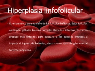 Hiperplasia linfofolicular
• Es un aumento en el tamaño de los folículos linfáticos. Estos folículos
contienen glóbulos blancos normales llamados linfocitos. El cuerpo
produce más linfocitos para ayudarle a los ganglios linfáticos a
impedir el ingreso de bacterias, virus u otros tipos de gérmenes al
torrente sanguíneo
 